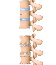 colonna vertebrale sana e colonna vertebrale affetta da osteocondrosi
