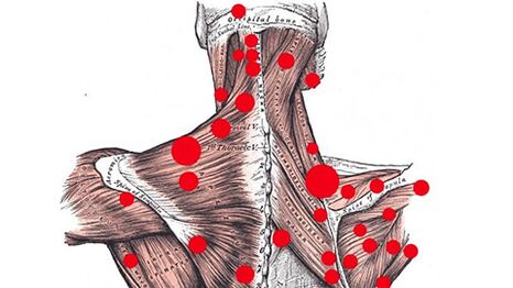 Punti trigger nei muscoli che provocano mal di schiena miofasciale
