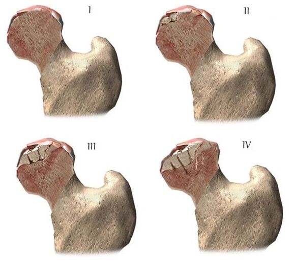 fasi di artrosi dell'articolazione dell'anca