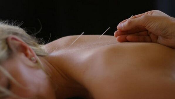 agopuntura per il mal di schiena