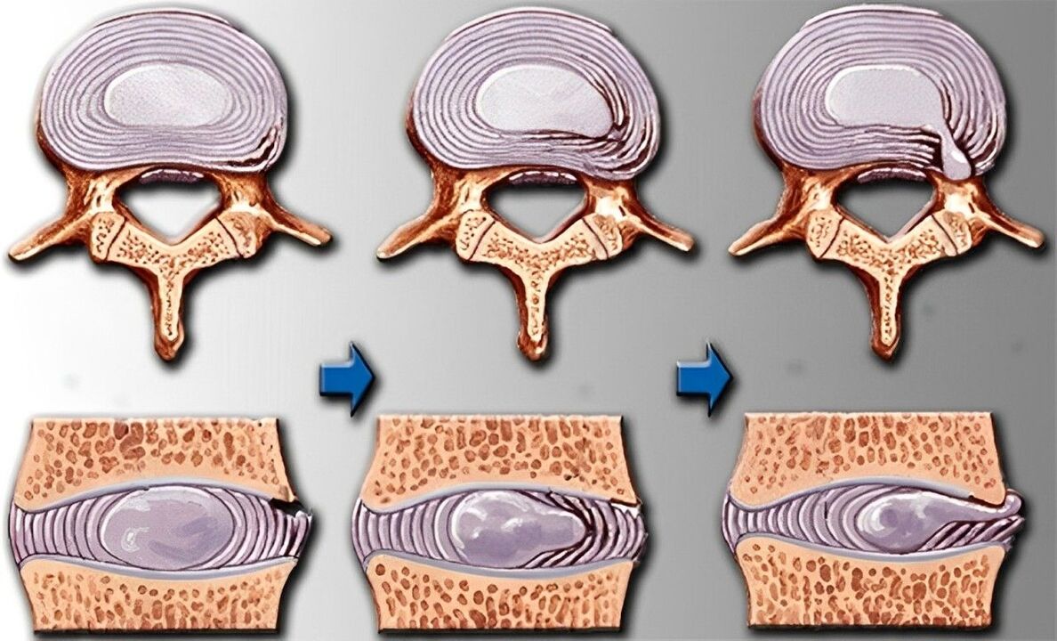 stadi dell'osteocondrosi