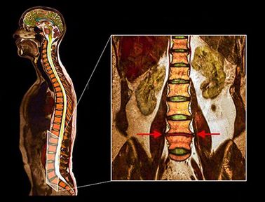 Disco degenerativo nella colonna vertebrale