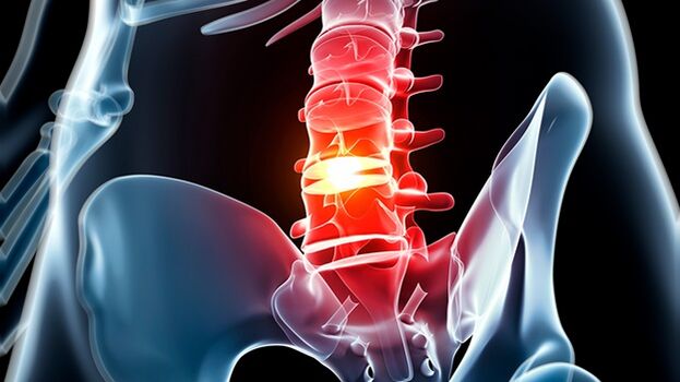 osteocondrosi della colonna lombare