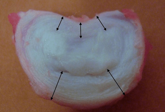 che aspetto ha un disco intervertebrale