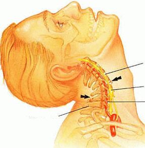 Osteocondrosi del rachide cervicale